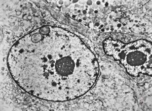 M,58y. | retroperitoneal liposarcoma